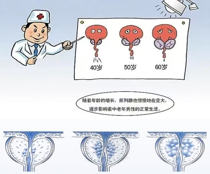 国内首个治疗良性前列腺增生复方制剂“爱廷列”正式上市，助力中国“健康老龄化”！